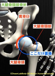 人工骨頭置換術と人工股関節全置換術 Tha の違いとは 手術の目的や適応をご紹介 理学療法士の新しい働き方改革 自分の力を最大限活かす方法や複業 副業 を大公開